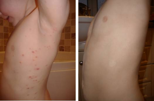 Molluscum before and after