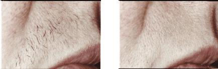 laser hair reduction before and after